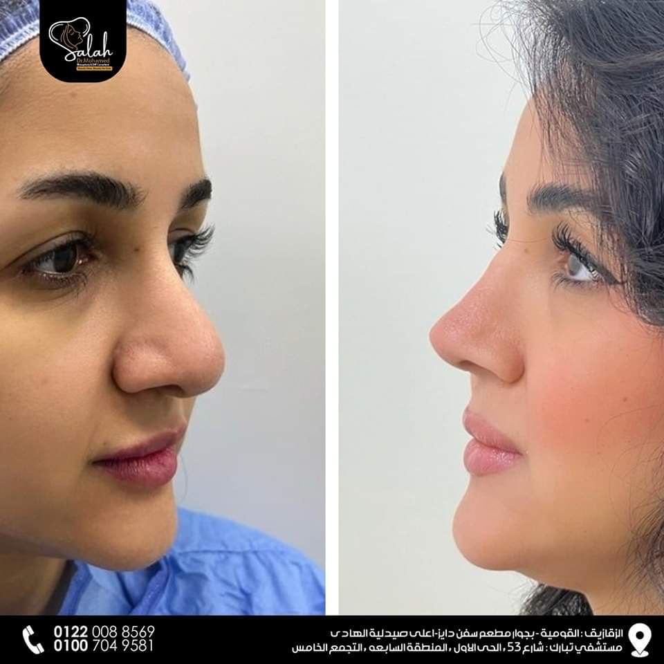 Bulbous Tip Rhinoplasty